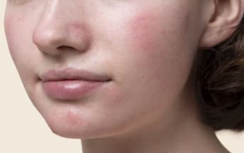 Rosacea e couperose del viso: rimedi naturali