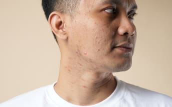 Hypothyroïdie et acné : quel lien ?