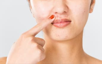 Acné près des lèvres : quelles sont les causes possibles et solutions?