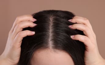 Pellicules sur les cheveux : causes et solutions naturelles