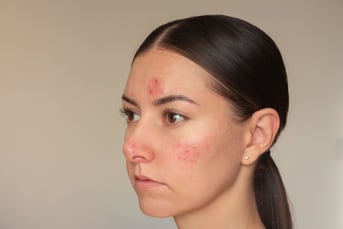 Psoriasis du visage : quelles solutions naturelles ?