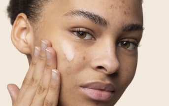 Acné et adolescence : quel lien ?