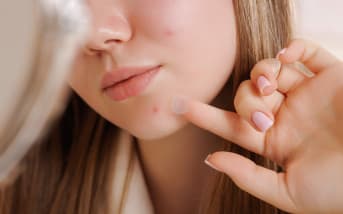 Patchs boutons : simples gadgets ou soin efficace ? Ce que l’on découvre en les testant…