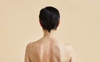 Acne sulla schiena: cause e possibili soluzioni naturali