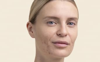 Quels remèdes naturels contre l'acné ?