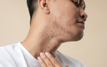 Les boutons après rasage : Nos solutions naturelles