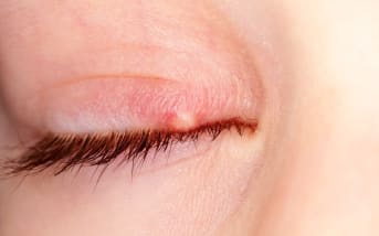 Swollen eyelid? The right steps to take to soothe a chalazion naturally