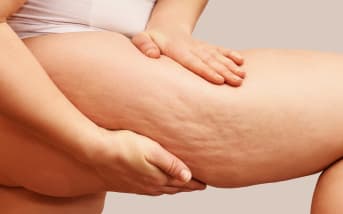 Comment se débarrasser naturellement de la peau d'orange (cellulite) ?