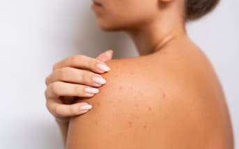 Boutons sous la peau : causes et solutions naturelles