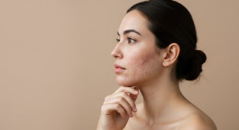Savon au lait de chèvre et acné : quels bienfaits pour la peau ?