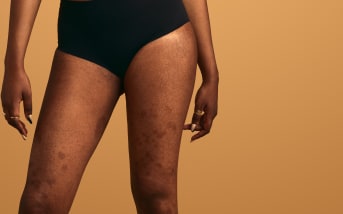 Naevus congénital : comment en prendre soin ?