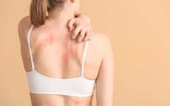Irritation de la peau : solutions naturelles pour une routine apaisante
