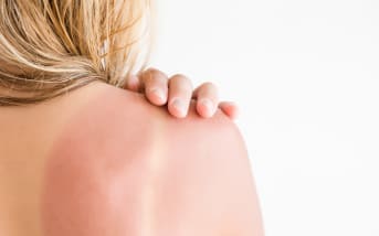 Premiers coups de soleil : les soins naturels pour réparer vite