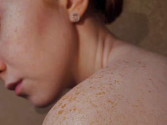 Problèmes de peau : qu'est-ce que le pityriasis versicolor, et comment le soulager naturellement ?