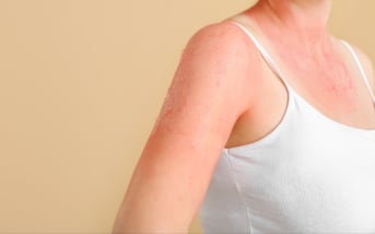 Quels sont les 4 types d'allergies ?