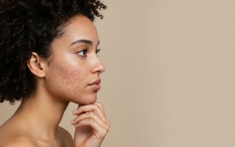 Sucre et acné : quel lien ?