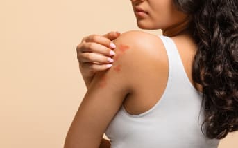 Comprendre les boutons d'allergie