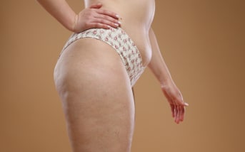 Tutto quello che c'è da sapere sulla cellulite