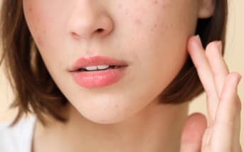 Acné au menton : Quels remèdes naturels ?