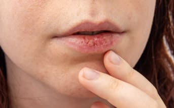 Vous avez tout essayé contre les lèvres gercées… sauf la bonne méthode