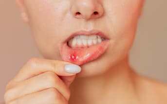 Mucocele labbro inferiore: cos’è, sintomi e rimedi naturali