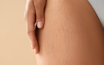 Vergeture qui gratte : nos solutions naturelles pour l’apaiser