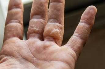 L'Eczéma dyshidrosique : symptômes, causes et solutions naturelles