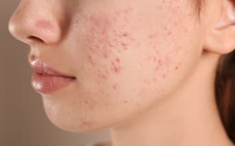 Cicatrice acné : Comment les atténuer naturellement ?
