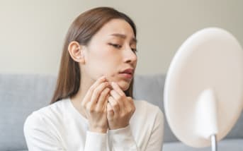 Acné au menton : Quels traitements naturels ?