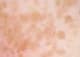 taches-rousseur-150x108