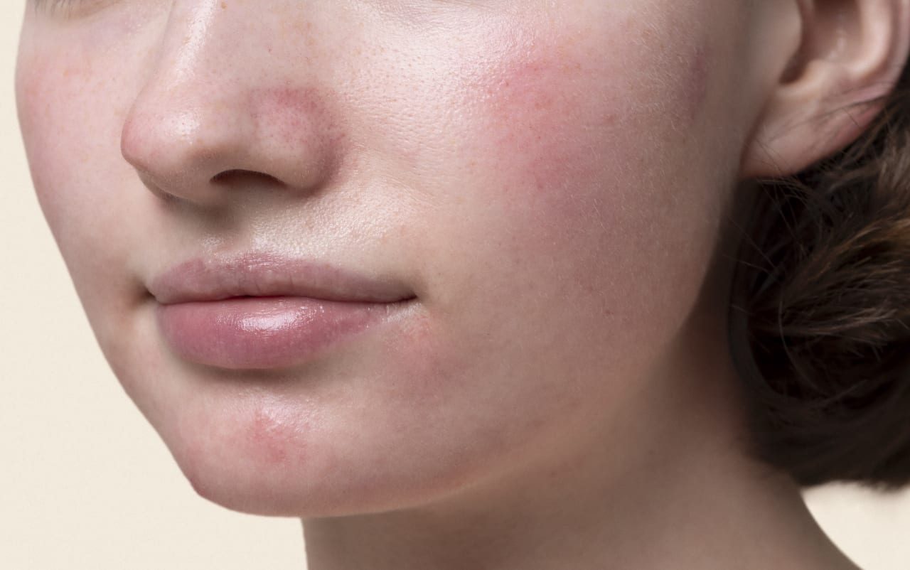 Rimedi naturali contro la couperose e la rosacea