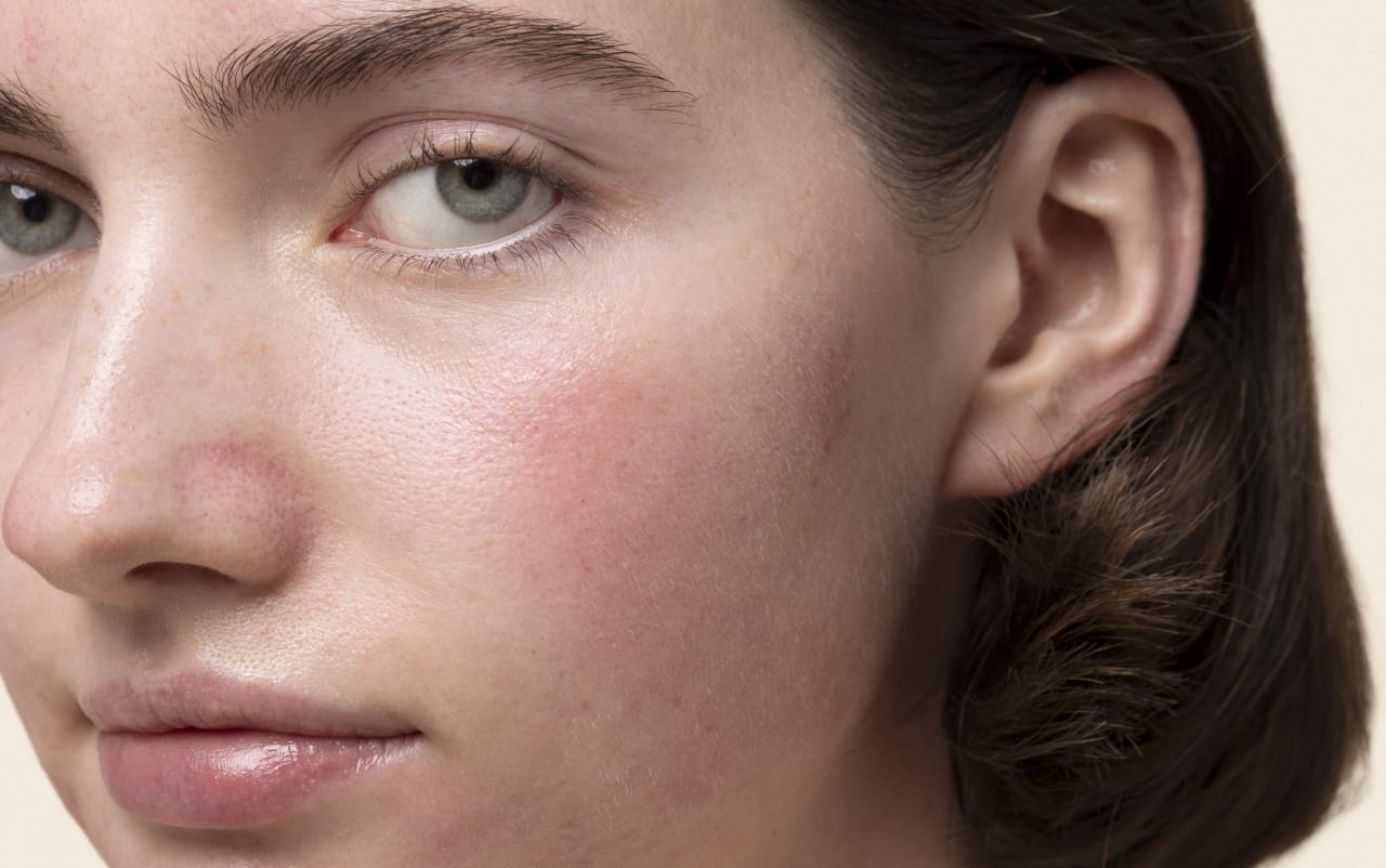 Peau sensible et rougeur : quel lien ? 