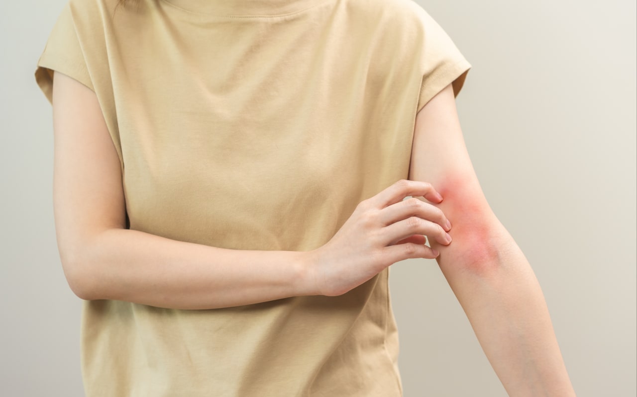 Allergia e macchie rosse sulla pelle: cause e sintomi 
