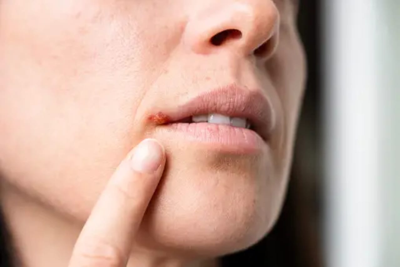 Fighting cold sores with natural remedies 