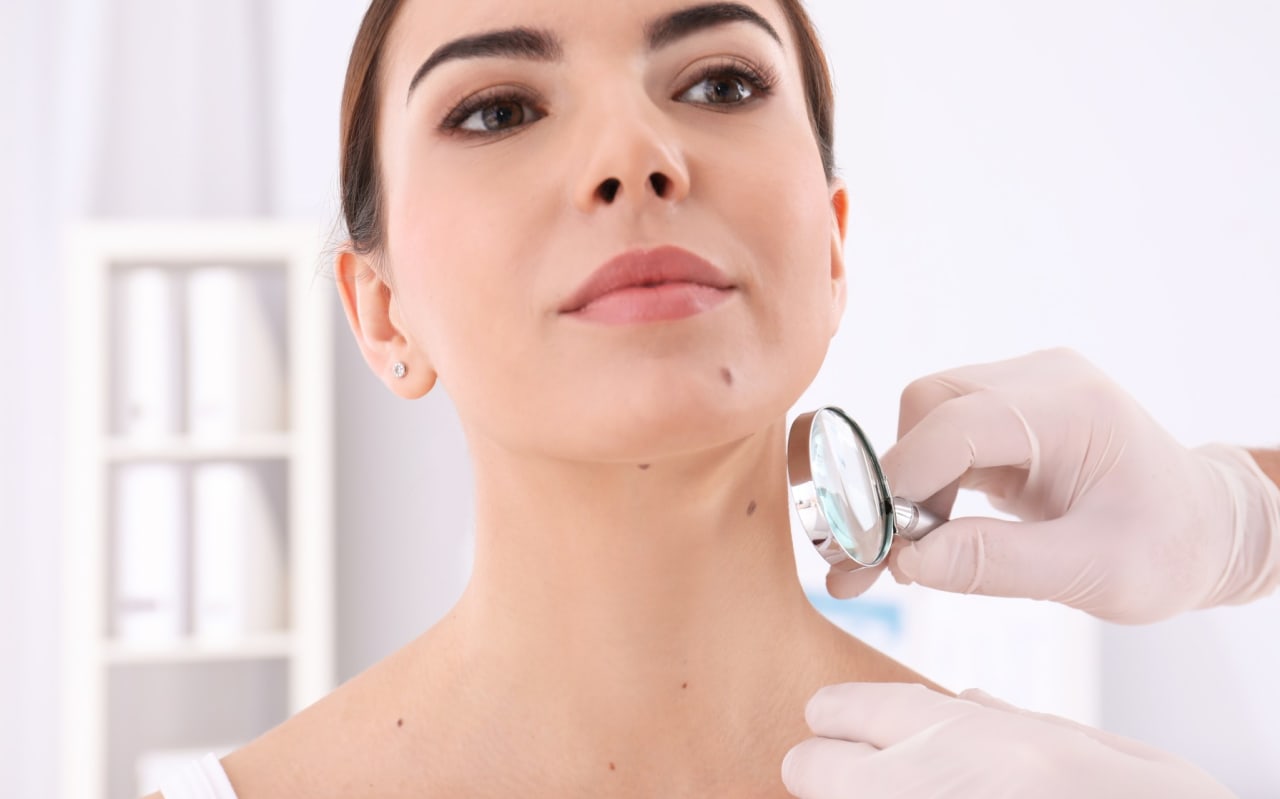 Grain de beauté qui saigne : que faire ?