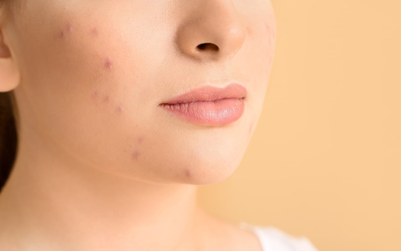 Bouton hormonal : causes, symptômes et solutions naturelles