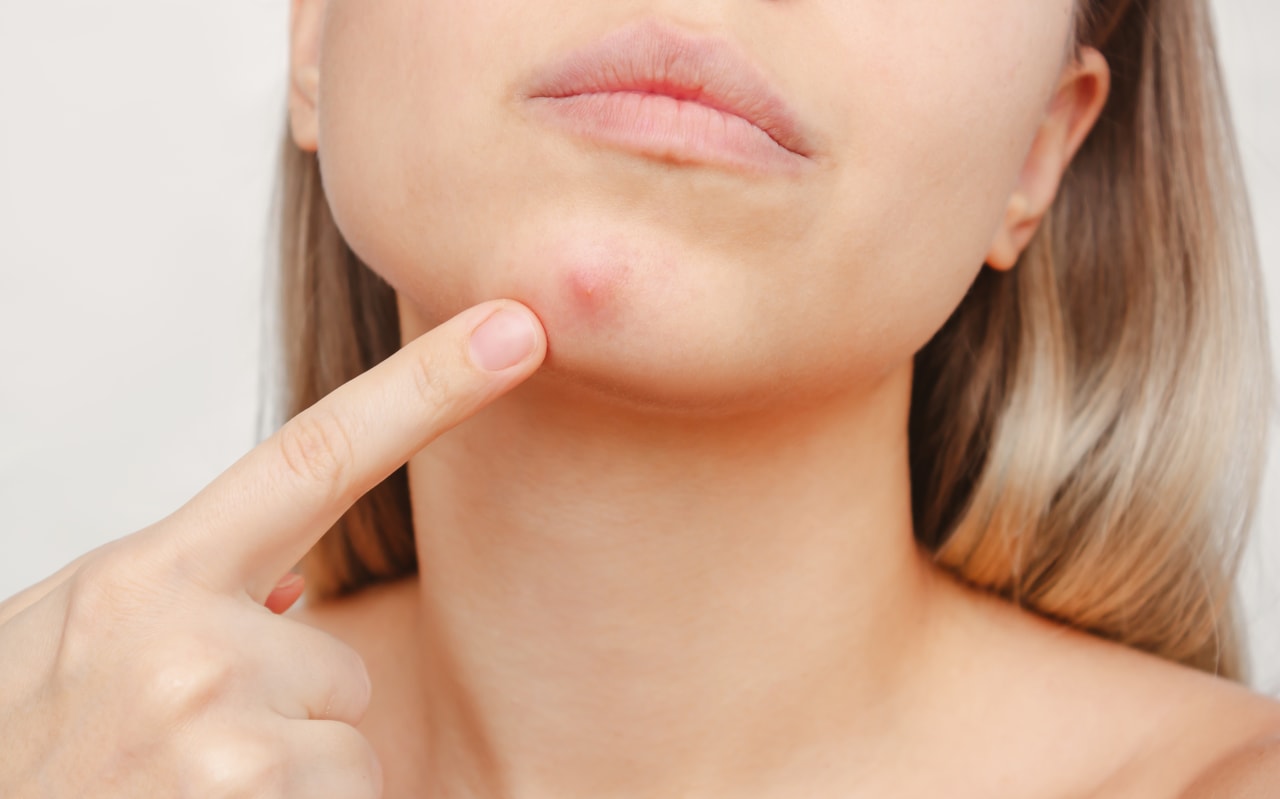 Comment prendre soin des boutons sur le menton naturellement ?