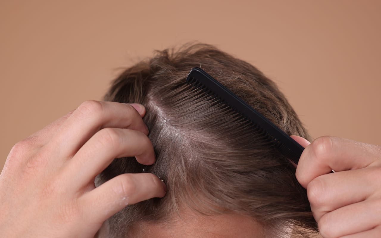 Capelli grassi con forfora: cosa fare?