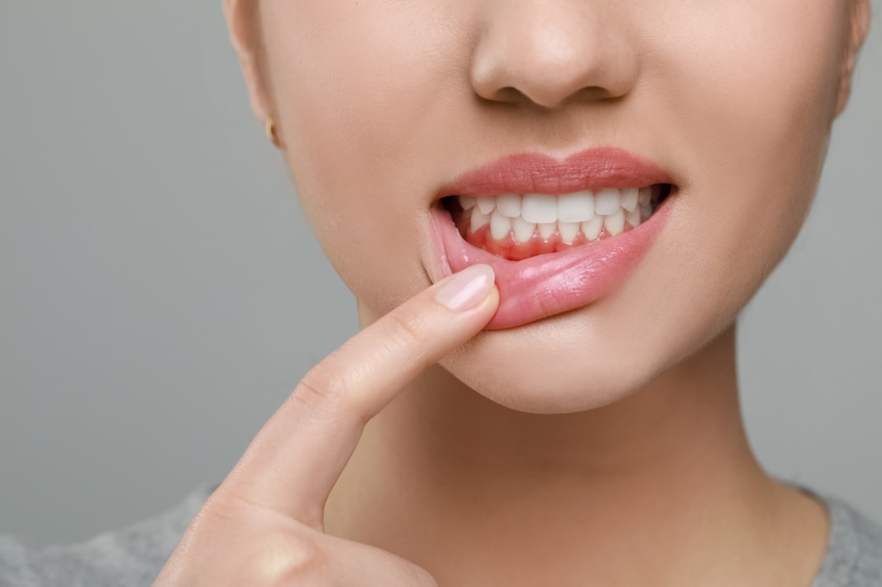 Tout savoir sur la gingivite : cause, solution, prévention