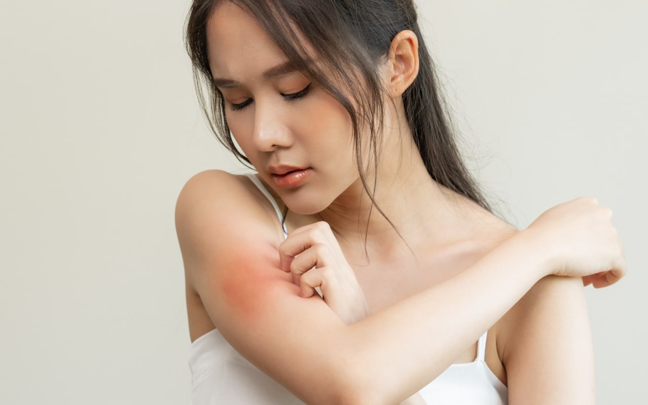 Tout savoir sur les allergies aux piqûres d'abeille