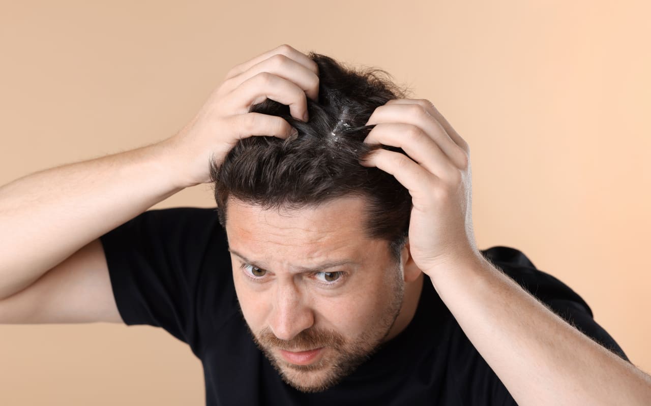 Pellicules sur les cheveux : causes et solutions naturelles