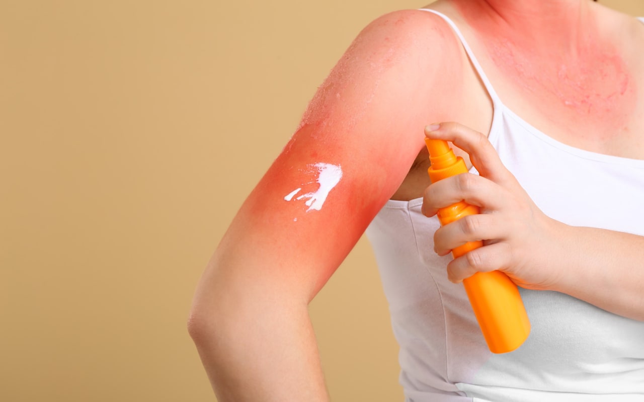 Allergie au soleil sur les bras : quelles solutions naturelles ?