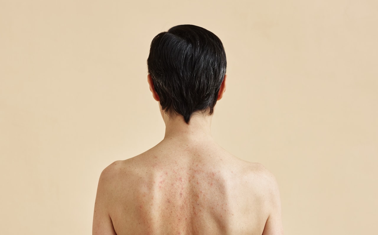 Acne sulla schiena: cause e possibili soluzioni naturali