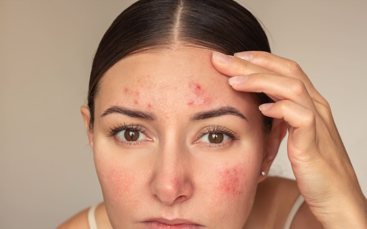 Comment enlever les boutons sur le front naturellement ?
