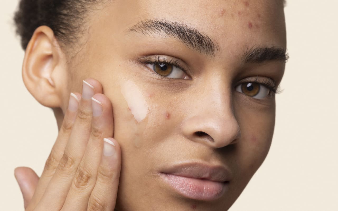 J’utilise des soins naturels contre mes imperfections, mais j'ai toujours des boutons ?