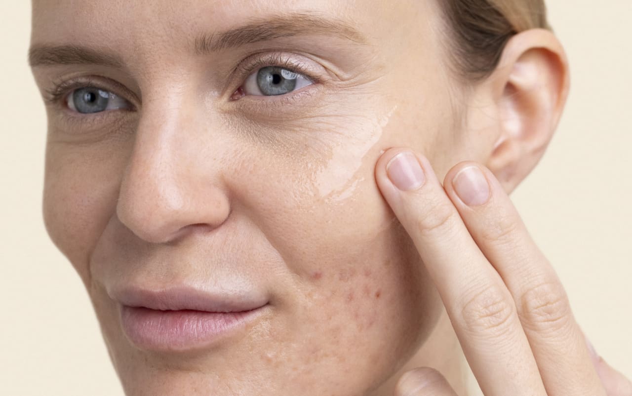 Aloe vera e acne: quali sono i benefici?