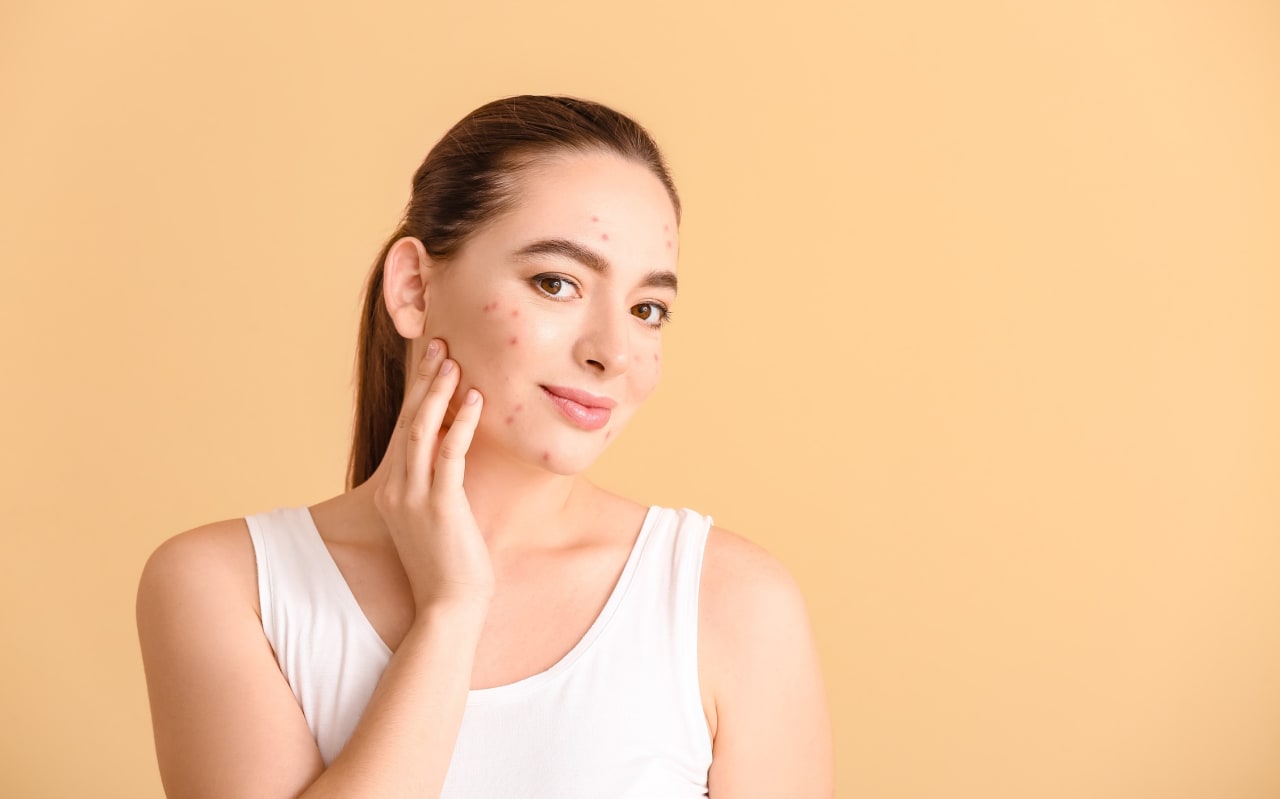 Mettre du dentifrice sur ses boutons : mythe ou réalité ?