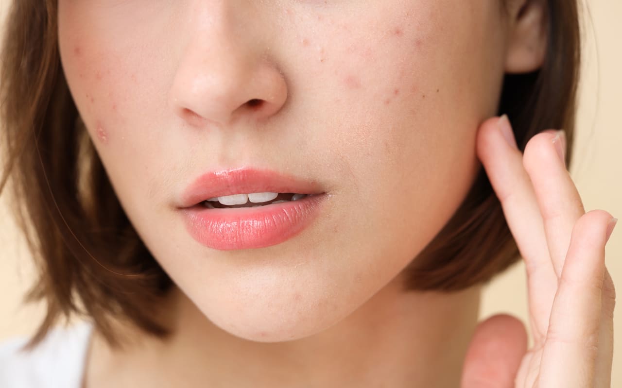 Qu’est-ce que l’acné hormonale ?