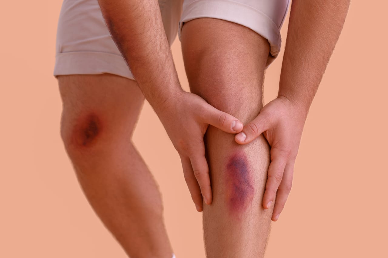How do you soothe a bruise, bump or haematoma?