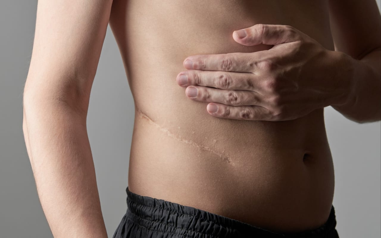 Come ridurre e prevenire la comparsa di cicatrici?